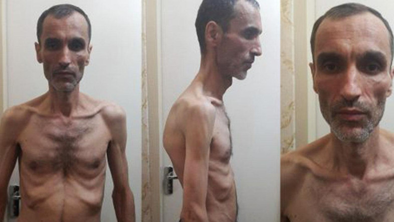 EMACIATED — These photos  show Hamid Baqai, a vice presdient under President Ahmadi-nejad, after a hunger strike in Evin Prison. 